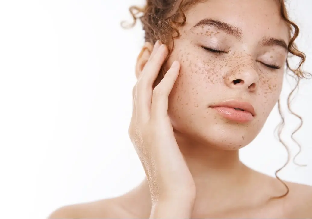5 dicas essenciais para quem tem melasma