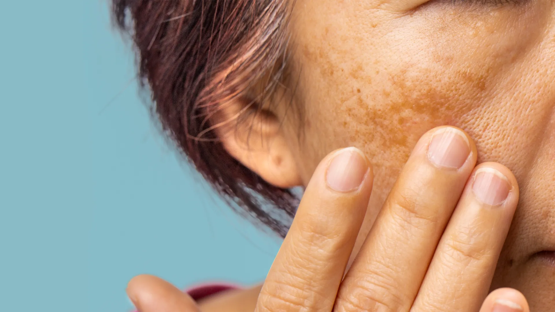 Melasma e manchas na pele: o que é e como tratar